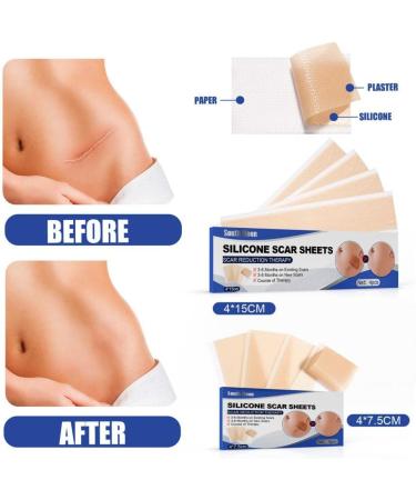 Universal Scar Repair Sticker | Soft Skin Patch | Lighten Pigmentation | Surgical Scar Repair | 4Pcs (Style A/S) - Buy Online on GoSupps.com