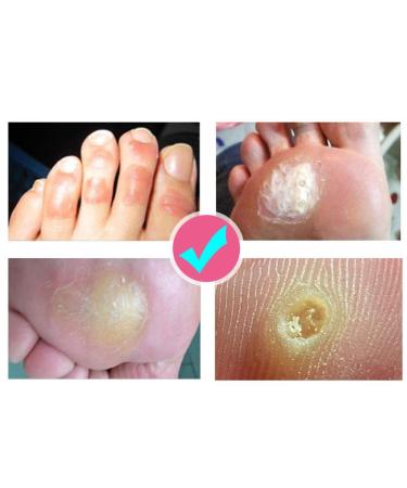 Foot Corn Plaster - Callus & Corn Removal Cream for Pain Relief - 10ml - Buy Online on GoSupps.com