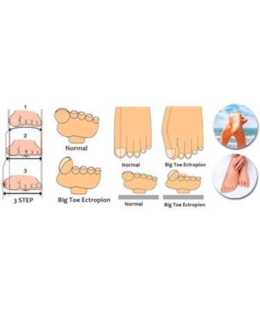 Sichun Gel Bunion Corrector - 1 Pair Toe Protectors & Straighteners | White Toe Spreader for Pain Relief - International Shipping Available - Buy Online on GoSupps.com