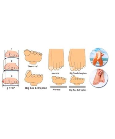 AnHua Silicone Gel Toe Cushion Pads - Bunion Protector & Toe Separator for Pain Relief (Clear) - Set of 2 - Buy Online on GoSupps.com