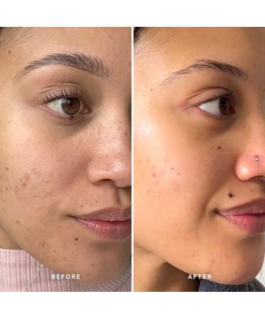 Alpha-H Liquid Gold and Scalp Exfoliating Treatment Bundle - Buy Online on GoSupps.com