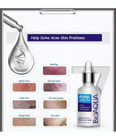 BIOAQUA 4-in-1 Acne Treatment & Scar Removal Cream - 100g + 30g + 30ml + 4pcs | Moisturizing Face Masks for Blemish Marks & Spots - Buy Online on GoSupps.com