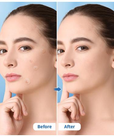 Buy Pimple Patches for Face - Hydrocolloid Acne Strips with Salicylic Acid & Tea Tree Oil - Effective Blemish & Pore Cleansing for All Skin Types - Buy Online on GoSupps.com