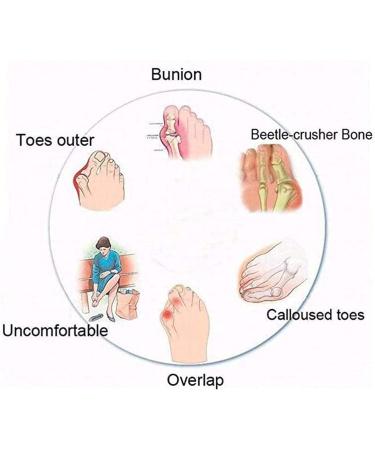 Orthopedic Women's Bunion Correction Sandals - Arch Support, Open Toe, Flat Sole - Buy Online on GoSupps.com