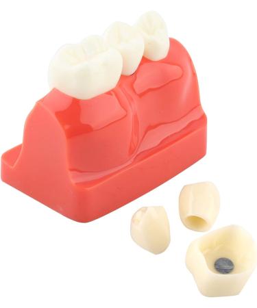 Implant Model Resin Dental Demonstration Demonstration Tooth Model Teeth Model Science Homework for Teaching Model School Dentist - Buy Online on GoSupps.com