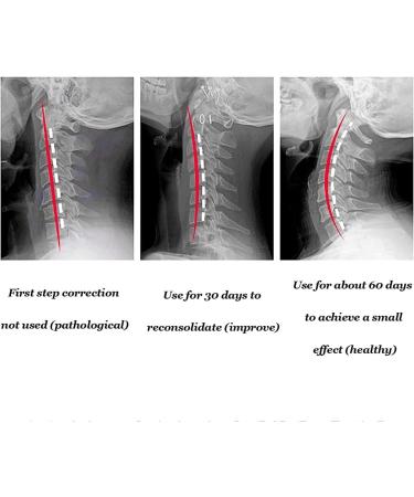 Safwel Neck Brace Collar - Support for Neck Pain Relief Posture Correction & Vertebrae Support | International Shipping Available - Buy Online on GoSupps.com