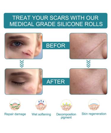 Medical Silicone Scar Tape Roll - 1.6'' x 120'' | Easy-Tear & Reusable | For Surgery, C-section, Keloid, Burns | 6-8 Month Supply - Buy Online on GoSupps.com