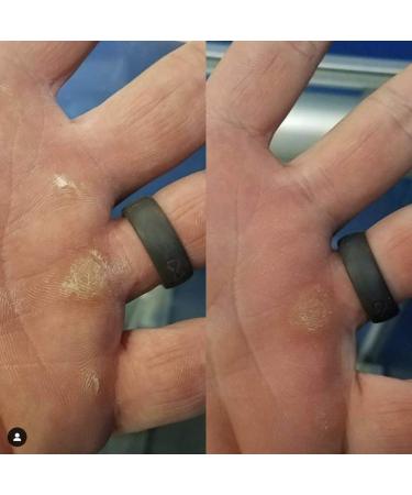 CaliCure Callus Remover Handcare Kit for Gymnastics & Cross Fitness - Repair Torn Hands, Climbing - 5in Orange - Buy Online on GoSupps.com