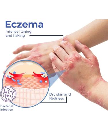 DUBUSH 2023 Eczema Therapy Spray - Natural Relief for Fast Acting Itch Relief and Hydration - 2pcs - Buy Online on GoSupps.com