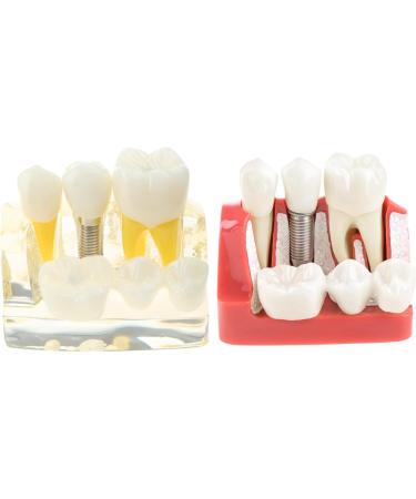Implant Model Removable Bridge - Educational Teeth Model for Dental Studies | Perfect for Demonstration Classes - Buy Online on GoSupps.com