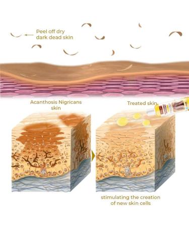 GFOUK Acanthosis Nigricans Dark Spot Peeling Oil - 1pcs - Buy Online on GoSupps.com