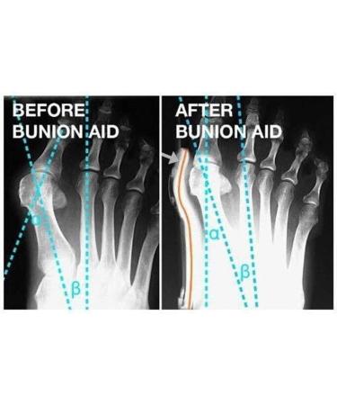 Hallux Valgus Corrector & Toe Spreader | Soft Breathable Relief for Left Foot Pain - Buy Online on GoSupps.com