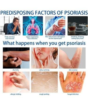 Eczema & Psoriasis Cream - Natural Relief for Dry, Itchy Skin | Scalp Rash Redness Acne - Buy Online on GoSupps.com