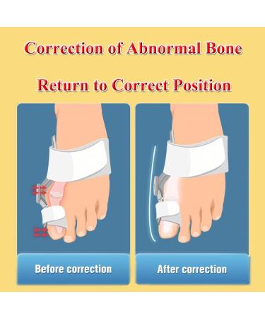 Silicone Big Toe Corrector & Separator for Hallux Valgus Bunion - 1 Pair - Buy Online on GoSupps.com