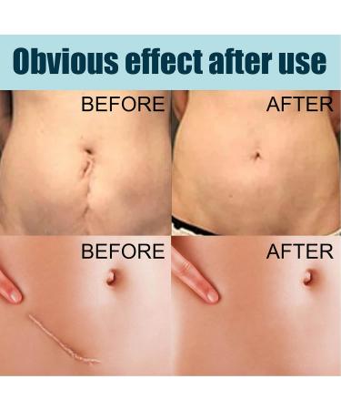 Stretch Mark Gel 2Pcs 50ml with Allantoin & Vitamin E - Hydrating Scar Remover for Scars, Burns & Surgery - Buy Online on GoSupps.com