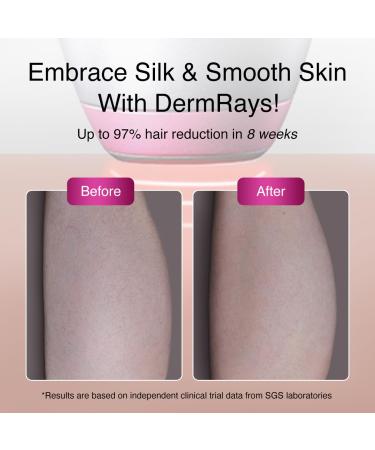 Upgraded Diode Laser Hair Removal for Dark Skin - DermRays 1064nm | Permanent Hair Reduction for All Skin Tones - Buy Online on GoSupps.com