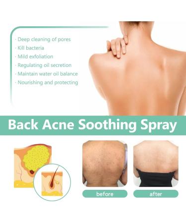 Herbaluxy Back Acne Treatment Spray - Clear Body Acne & Lighten Marks Deep Cleans & Gentle on Skin - Buy Online on GoSupps.com