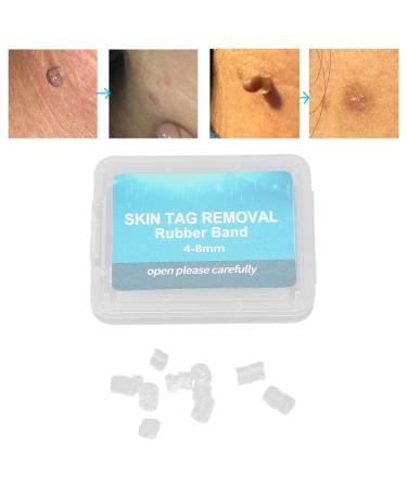 30-Piece Skin Tag Remover Rubber Bands for Small Tags | Effective Mole & Facial Care Tool (4-8mm) - International Shipping Available - Buy Online on GoSupps.com