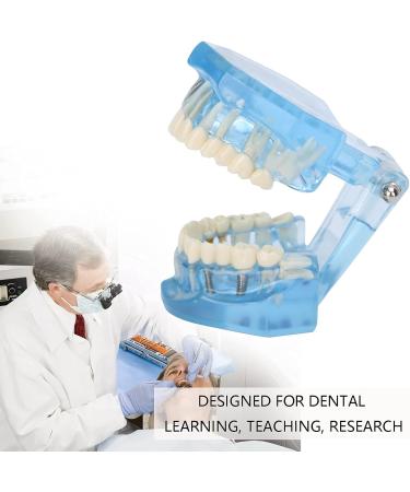 Adult Dental Implant Tooth Model - Blue-Transparent Acrylic for Pedagogical Demonstration | Removable Simulation for Dentists - Buy Online on GoSupps.com