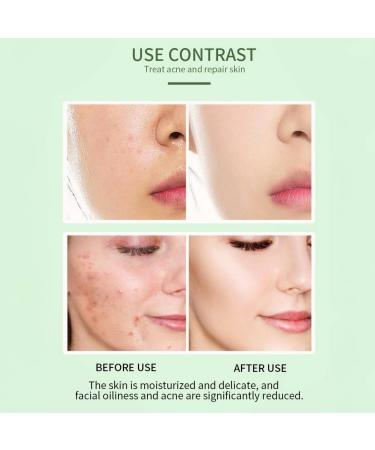 2% Salicylic Acid Serum for Acne & Open Pores | Reduces Oil & Bumpy Texture | BHA Exfoliant for Oily Skin | Unisex | 1 Fl Oz (30ml - Buy Online on GoSupps.com