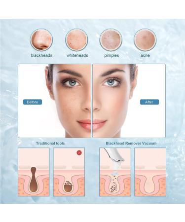 Blackhead Remover Pore Vacuum black head remover for face with 5 Suction Power & 1080P HD Camera - Buy Online on GoSupps.com