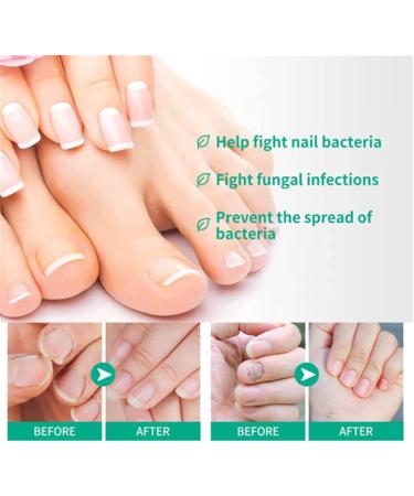 Fungus Treatment Oil Foot Fungus Oil Kerasentials Nail Treatment Healthy Natural Repair Nails Natural Toenail for Damaged & Discolored Toe Nails (2pcs) - Buy Online on GoSupps.com