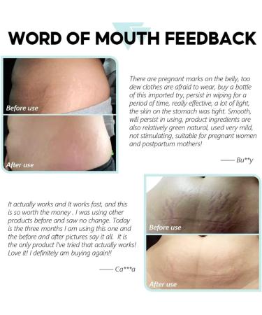 Stretch Mark Removal Acne Scar Stretch Fat Striae Gravidarum Treatment Repair Anti Aging Angles Firming Body Care (1 Piece) - Buy Online on GoSupps.com