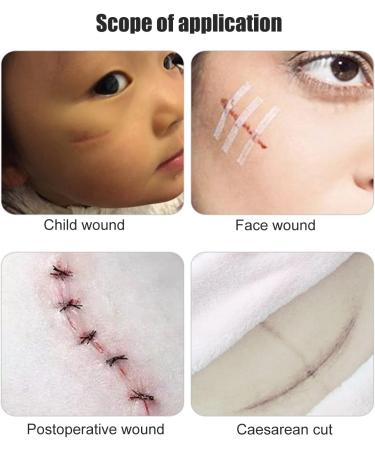 Wound Closure Bandage 10pcs- Portable Breathable Skin Closure Strap for Adult Protection - 0.2 X 3.9in - 2 Sheets - Buy Online on GoSupps.com