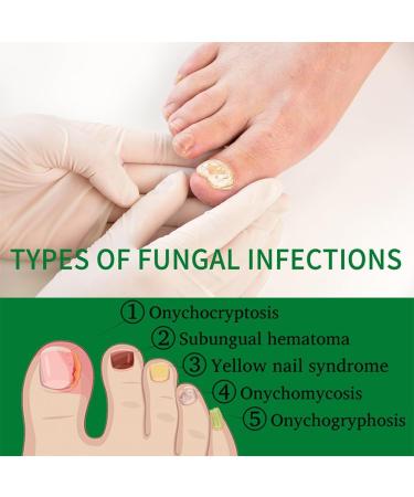 dizhenhui104jiaju LYEAA Nail fungus treatment 7 days nail fungus treatment toenails cuticle care oil ginger nail serum nail strengthening oil for damaged nails 1 piece - Buy Online on GoSupps.com