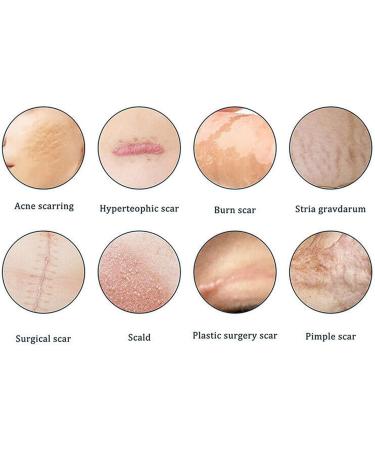 German Advanced Skin Renewal Gel Scar Gel For Acne Scars Stretch Mark Removal Cream Advanced Scar Treatment Natural Scar Therapeuti Gel Scar & Stretch Marks Remover Gel (3pcs) - Buy Online on GoSupps.com