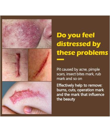 Scar Removal Cream for Face & Body - Skin Remover for Scars & Marks (White, One Size) - Buy Online on GoSupps.com