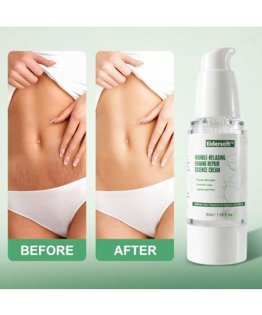 Maternity Stretch Mark Removal Cream | Natural Anti-Wrinkle & Firming Formula for Skin Rejuvenation - Buy Online on GoSupps.com