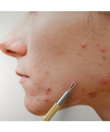 SC-11103-GLD Suvorna Whitehead Remover | Effective Pimple & Cyst Removal Tool for Clear Skin - Buy Online on GoSupps.com