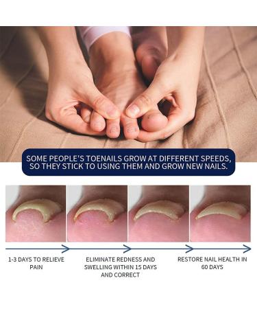 German ToenailPlus Anti Paronychia Relief Oil - Repair Damaged Nails (2 Pcs) - Buy Online on GoSupps.com