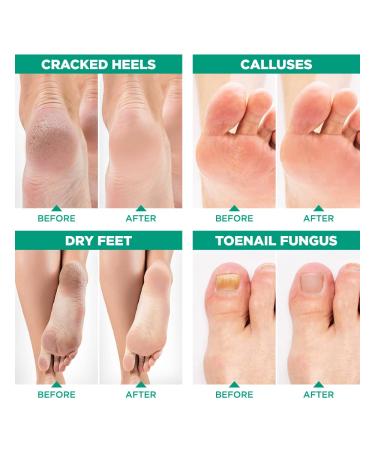 Tea Tree Oil Foot Soak with Epsom Salt for Toenail Fungus & Athlete's Foot - Made in USA - 1 lb - Buy Online on GoSupps.com