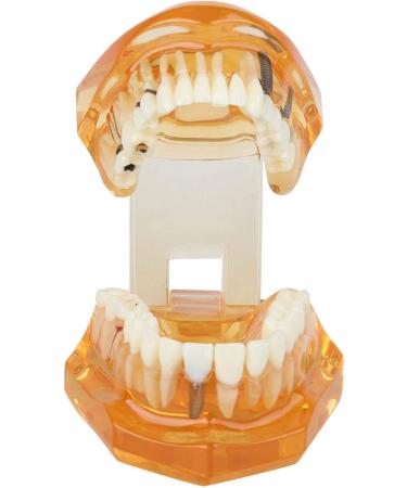 Dpofirs Orange Dental Model - Removable Teaching Tool for Dental Programs Adult Tooth Demonstration & Dental Implants - Buy Online on GoSupps.com