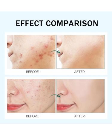 Anti Acne Face Cream Ance Gel Nourishing Formula - Buy Online on GoSupps.com