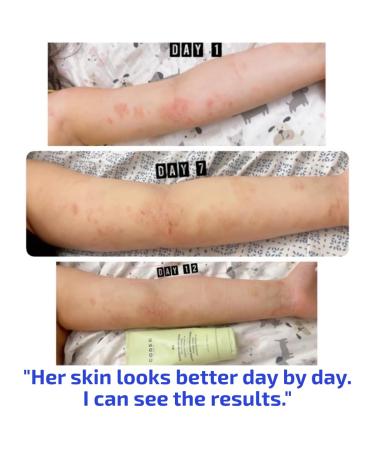 Codex Labs BIA Eczema Relief Lotion 3.4 oz - Clinically Proven Colloidal Oatmeal 1% for Itchy Dry Eczema Prone Skin - Fragrance Free Moisturizer with BiaComplex 2.0 - Safe for Babies Kids & Adults - Buy Online on GoSupps.com