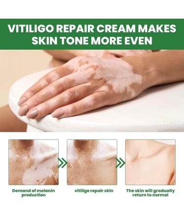 Revitalize Eelixirs Vitiligo Cream Treatment Ointment | Repigmentation & Soothing Moisturizer for Skin | Vitiligo Fix - 1pcs - Buy Online on GoSupps.com