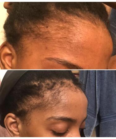 Allurium Hair Growth Serum for Black Women - African Formula with Natural Ingredients for Longer, Thicker Hair - 2 Bottles - Buy Online on GoSupps.com