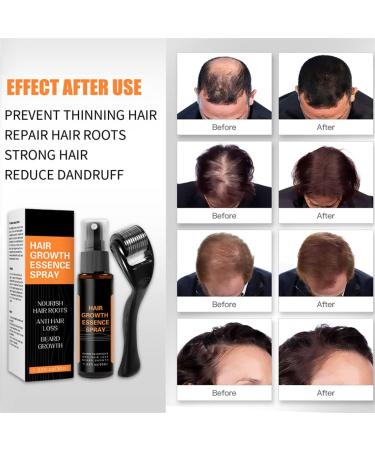 Spray Repousse Cheveux + Rouleau Repousse Cheveux Spray Repousse Cheveux Pour Hommes Femmes Spray Repousse Cheveux L'huile De Gingembre Stoppe La Chute Des Cheveux (Spray+Roller) - Buy Online on GoSupps.com