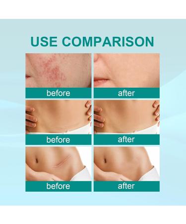 Medical Grade Scar Spray for Acne & Surgical Scar Removal - 2PCS - Buy Online on GoSupps.com