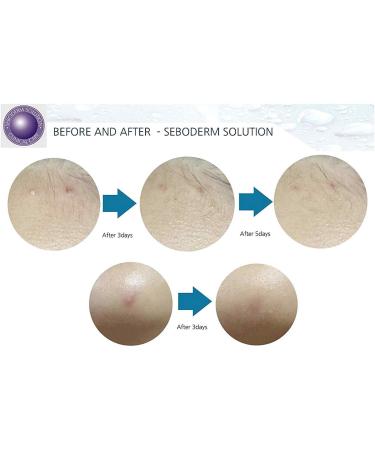 Buy Acne Seboderm Solution - Anti Sebum Treatment for Blemish-Prone Skin | Pore Shrinking Care Worldwide Shipping - Buy Online on GoSupps.com