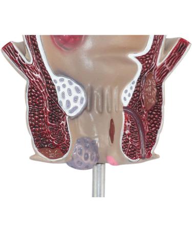Rectum Model Human Pathological Diseases Rectum Ulcus Acne Pathological Model Use for Model Hemorrhoid Model Demonstration of Anorectal Diseases - Buy Online on GoSupps.com
