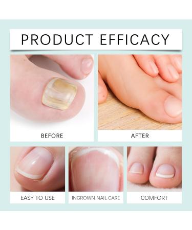  JIAOY Natural Nail Care Gel Strengthening Serum for Damaged and Brittle Cuticles Nail Growth Repair Cream Foot Moisturizer and Repair Cream (1PCS) - Buy Online on GoSupps.com