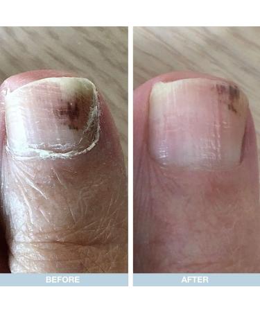 Feet and Nails Care Kit with Tea Tree Oil - Foot Cream Heel Repair and Nail Repair for Softer Healthier Feet and Nails - Moisturizes Soothes and Repairs Dry and Cracked Heels - Buy Online on GoSupps.com