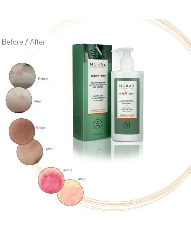 Moraz Polygonum Herb Atopic Cream - Soothing Redness Reducing Skin Care for Irritated & Itchy Skin - Steroid-Free Relief - 8.5 oz - Buy Online on GoSupps.com