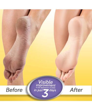 2 X Krack Heel Repair | Ayurvedic Foot Care Cream - Repair Dry Cracked Heels | 25g x 2 Pack - Shop Internationally! - Buy Online on GoSupps.com