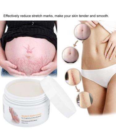 Stretch Stripes Cream 120g | Remove Stretch Marks Pregnancy Scars & Acne | Maternity Repair Treatment - Buy Online on GoSupps.com