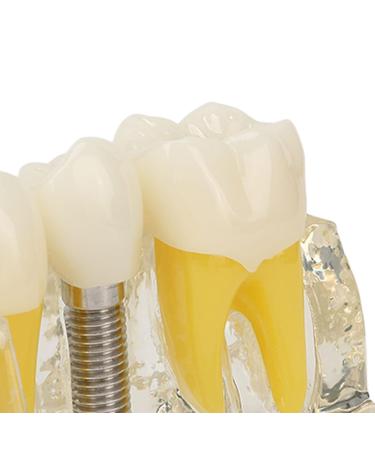 Transparent Tooth & Dental Implant Model | High Accuracy Resin | Effective Demonstration | International Shipping - Buy Online on GoSupps.com